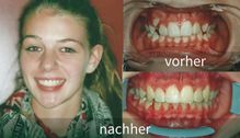 Kieferorthopädie vorher nachher