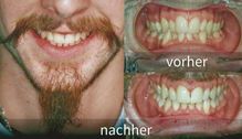 Kieferorthopädie vorher nachher